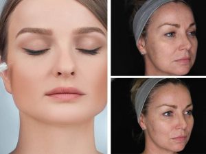 Structural Contouring vs. Soft Volumization: The Role of Calcium Hydroxylapatite in Jawline Definition